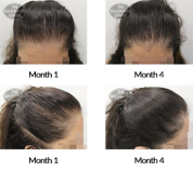 alert female pattern hair loss the belgravia centre 406779 08 12 2020