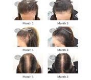 alert female pattern hair loss the belgravia centre 16 11 2020