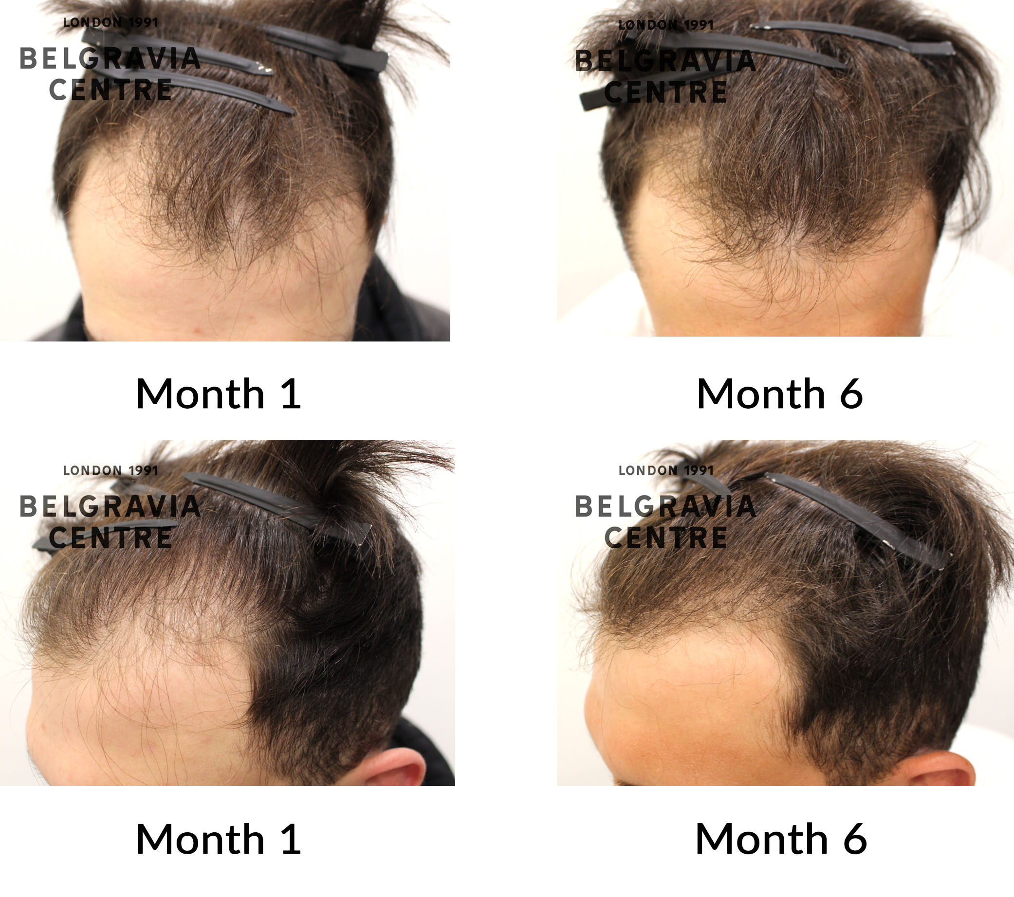 Hair Loss Success Story: 