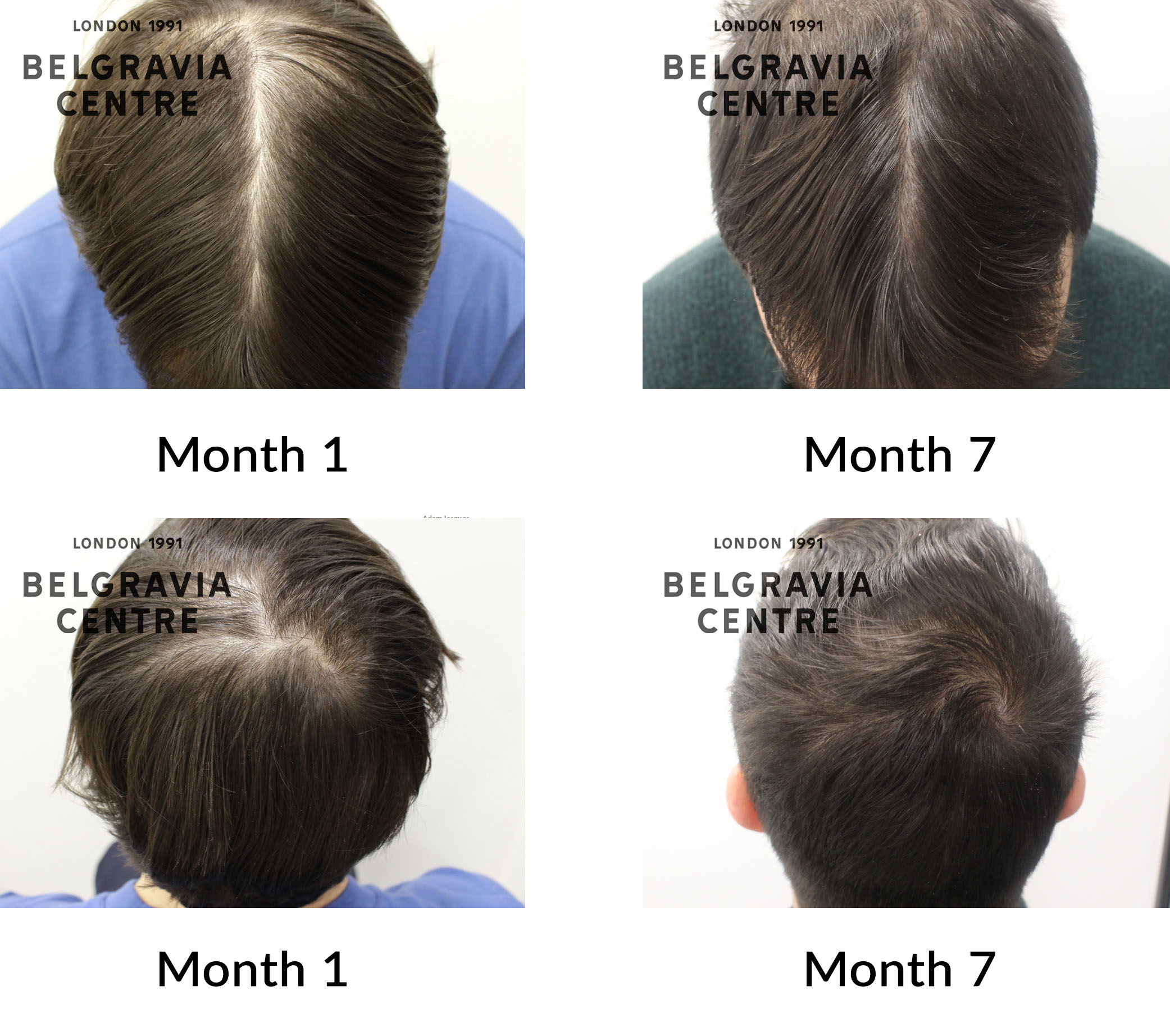 3 month hair growth men