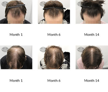 Success Story Alert! New Male Hair Loss Treatment Entry