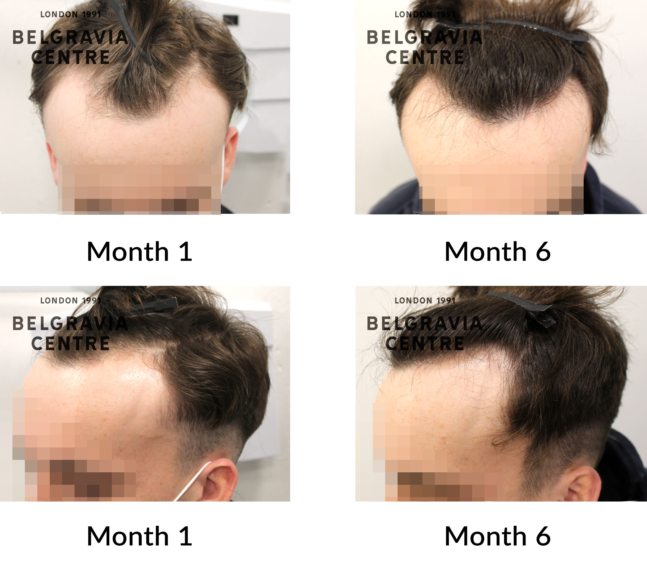 Hair Loss Success Story: 