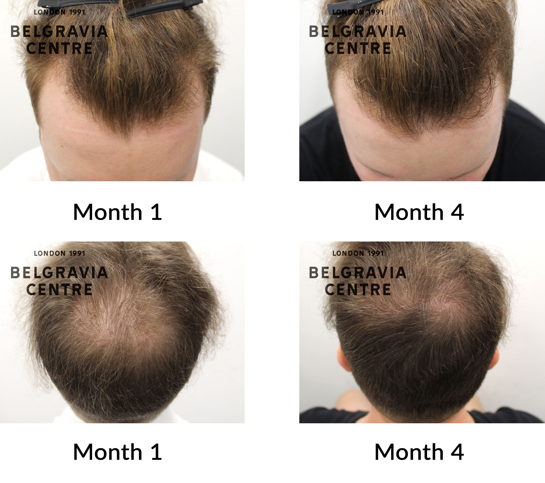 Hair Loss Success Story: 